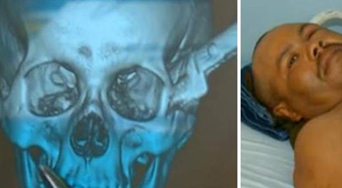 Başına saplanan bıçakla iki saat araba kullandı Başına saplanan bıçakla iki saat araba kullandı