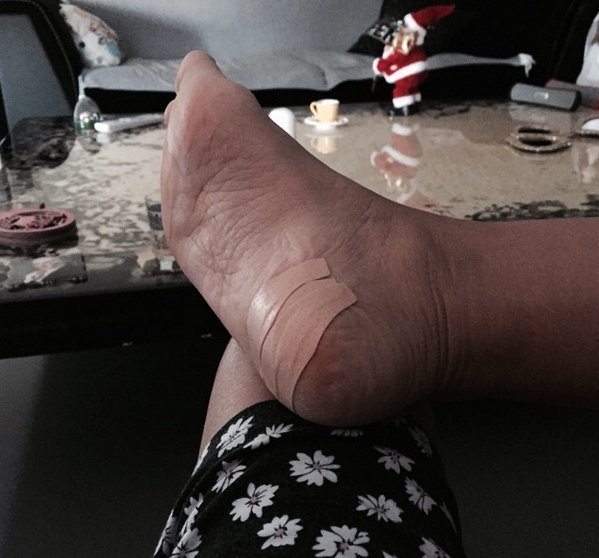 Demet Akalın'ın ayağına cam battı Demet Akalın'ın ayağına cam battı