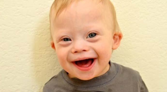 21 Mart Down Sendromu Farkındalık Günü (DOWN SENDROMU NEDİR) 21 Mart Down Sendromu Farkındalık Günü (DOWN SENDROMU NEDİR)