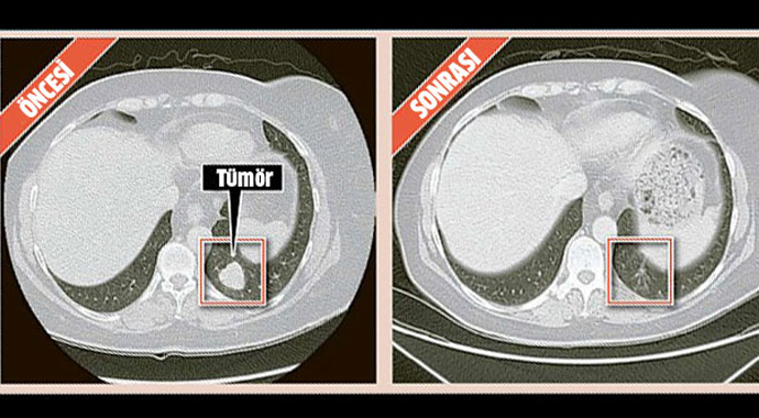 Kemoterapi tedavisi tarihe karışıyor Kemoterapi tedavisi tarihe karışıyor