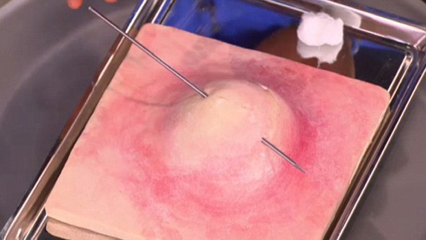 Mehmet Öz'den sivilce önerisi! Mehmet Öz'den sivilce önerisi!