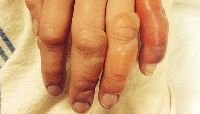 Uyandığında parmakları bu haldeydi!