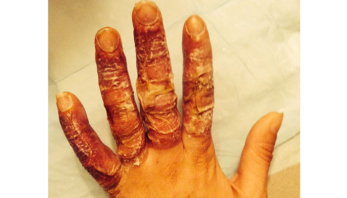 Uyandığında parmakları bu haldeydi!